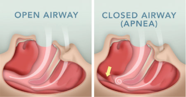 Sleep apnea symptoms for OSA include having your airways blocked 