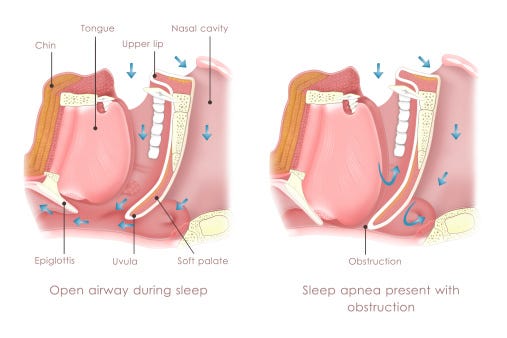 What is sleep apnea? The major disorder affecting millions 