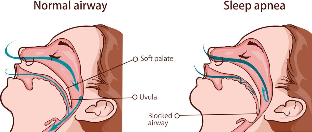 Trial: Oral Surgery Helps in Sleep Apnea - MedPage Today